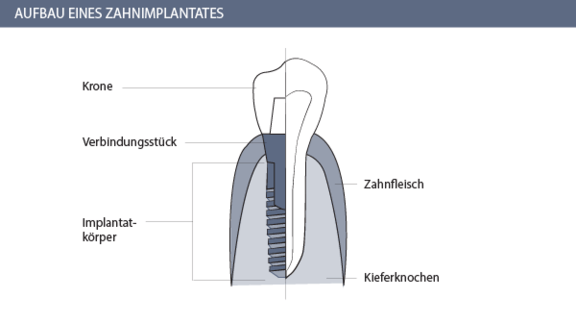 Aufbau Zahnimplantate, Zahnarzt für Zahnimplantate in Zürich